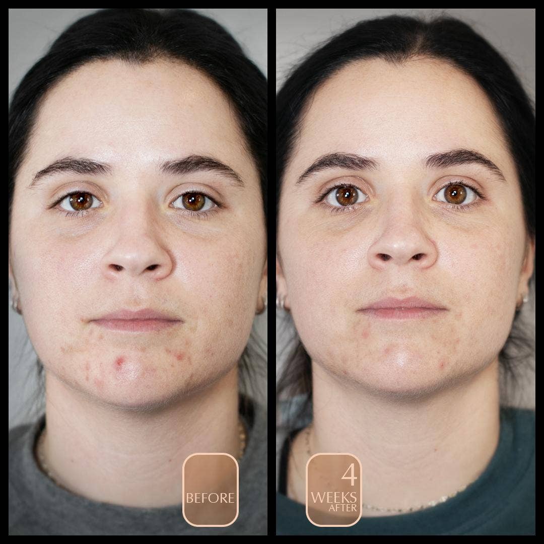 Aureterra - Acne Organic Face Cream with Rose Hydrosol