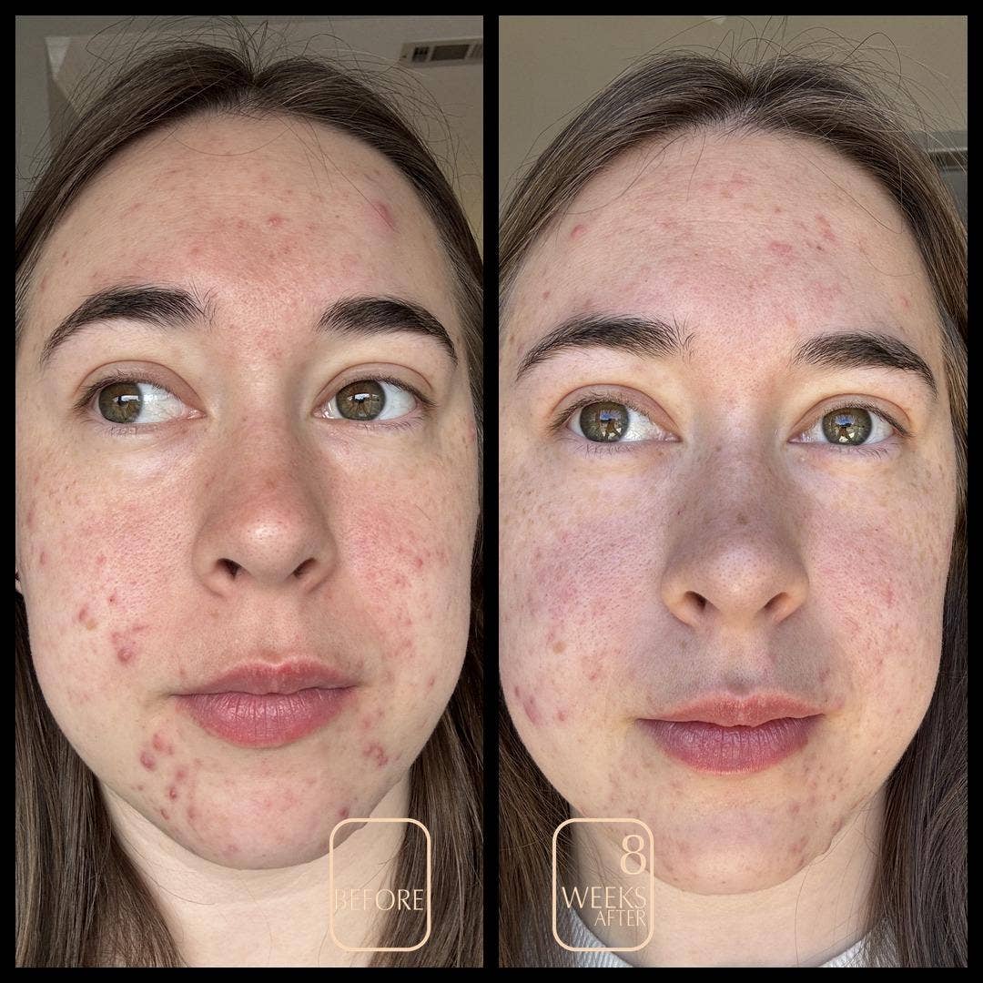 Aureterra - Acne Organic Face Cream with Rose Hydrosol